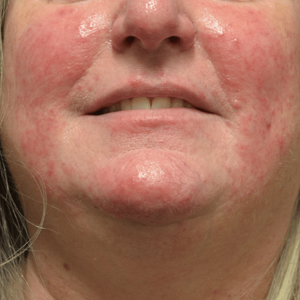 inflamed rosacea
