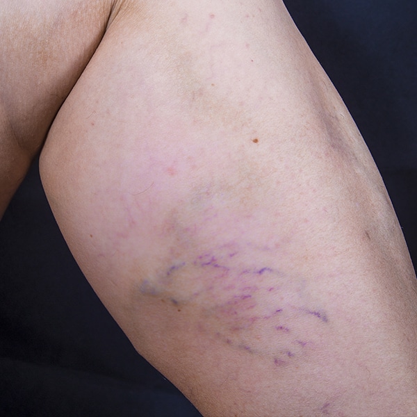 woman's calf with spider and varicose veins