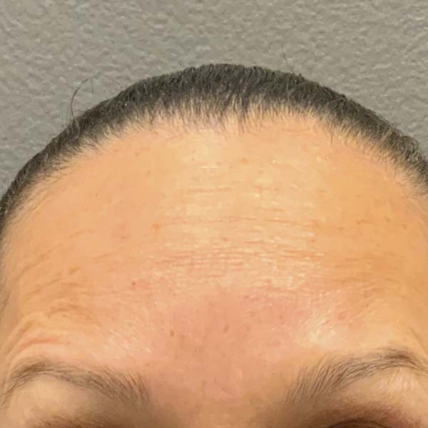 Botox® & Xeomin® 34 After