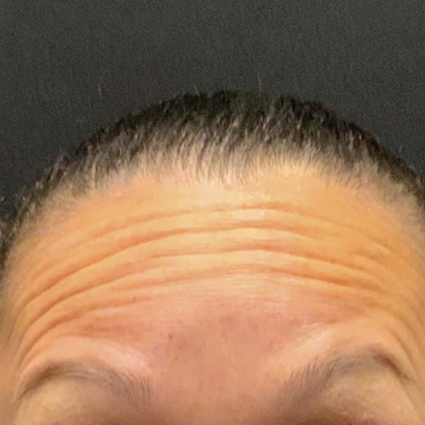 Botox® & Xeomin® 33 Before