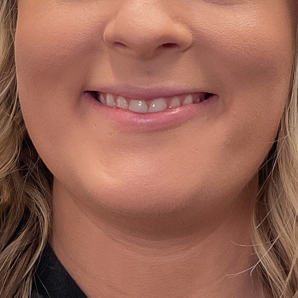 Botox® & Xeomin® 36 After