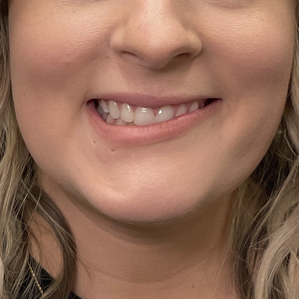 Botox® & Xeomin® 35 Before