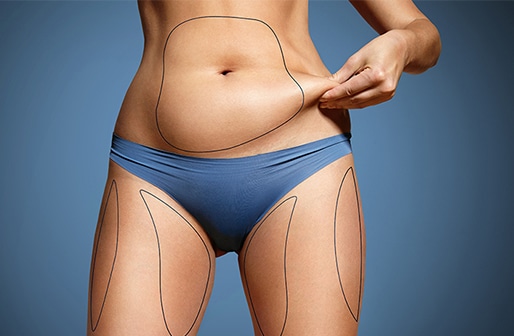 April blog difference between coolsculpting and liposuction