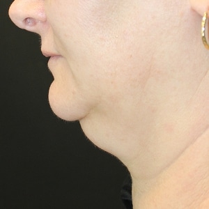 Double chin before treatment