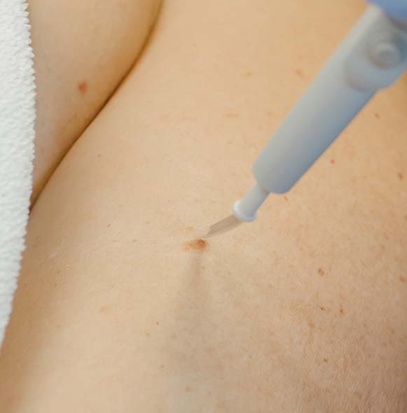 Electrocautery mole removal Electrocautery mole removal