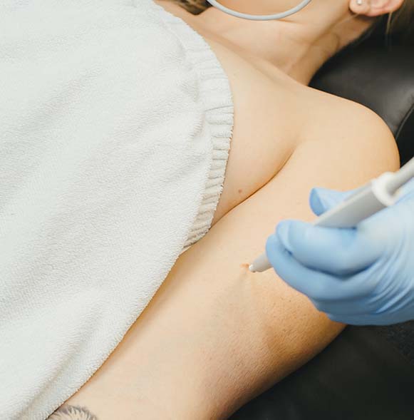 Electrocautery skin tag removal Electrocautery skin tag removal