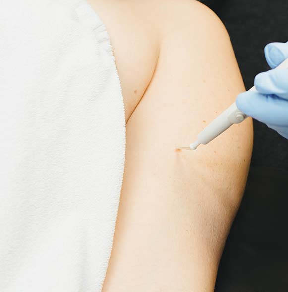 Electrocautery removal Electrocautery removal