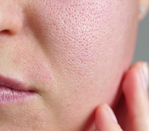 Treatments for enlarged pores