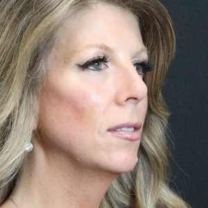 Woman looking to the side after dermal filler with volume in her cheeks and face.