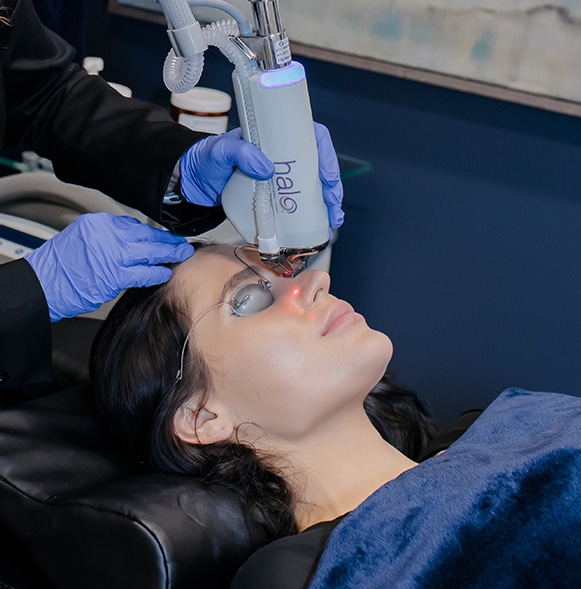 Halo Laser Treatment Around Nose