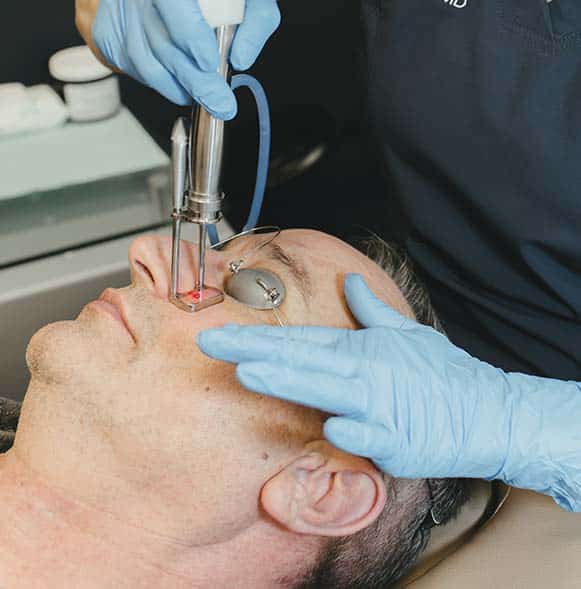 Close up of a laser vein treatment on a man’s nose Close up of a laser vein treatment on a man's nose