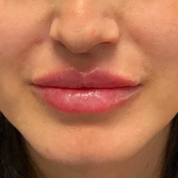 Dermal Fillers 24 After