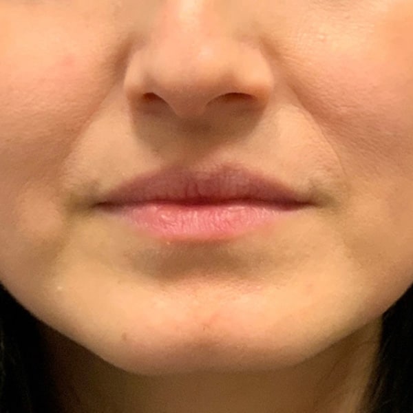 Dermal Fillers 23 Before