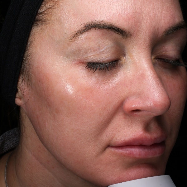 woman with clear skin after a halo pro treatment