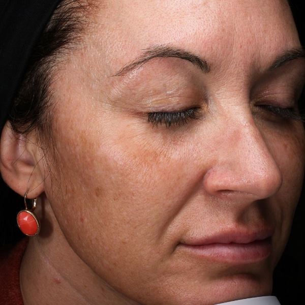 woman with melasma