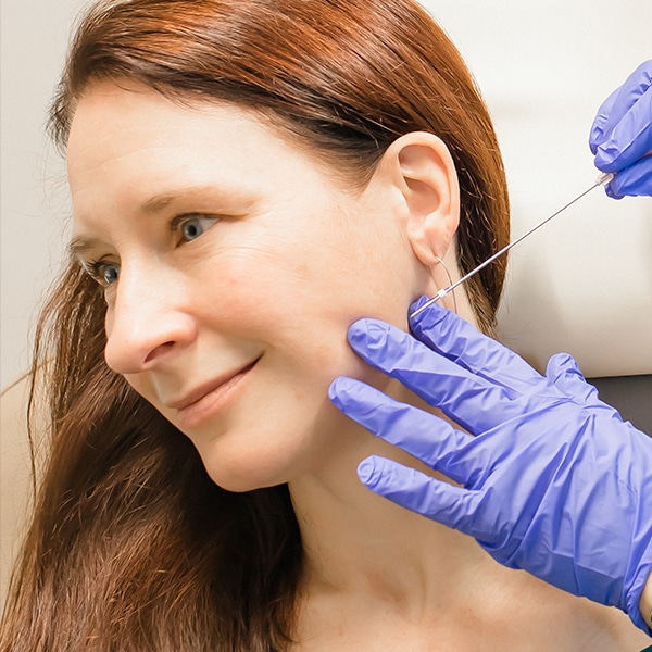 Physician is placing PDO thread along the jawline to reduce the appearance of jowls.