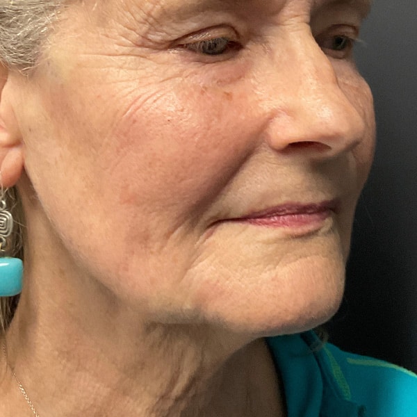 Dermal Fillers 22 After