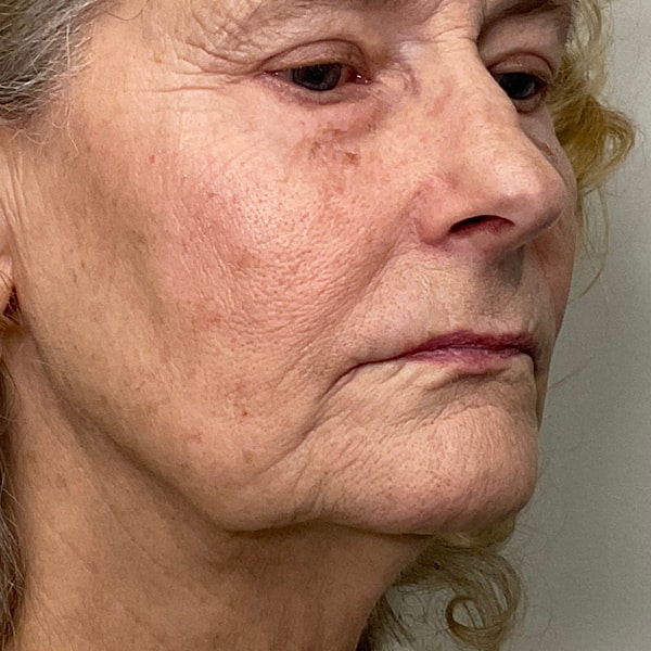 Dermal Fillers 21 Before