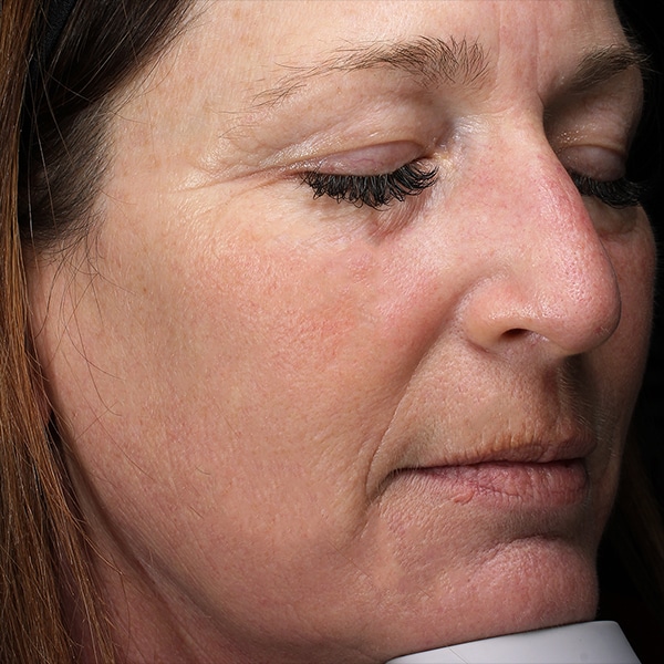 Halo® Pro 4 Halo Laser Before and After | After Picture