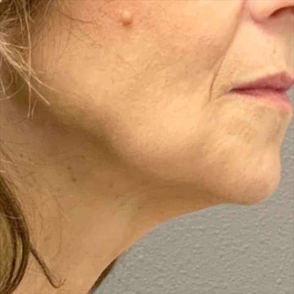 PDO Threads 20 Thread Lift Before and After | After Picture