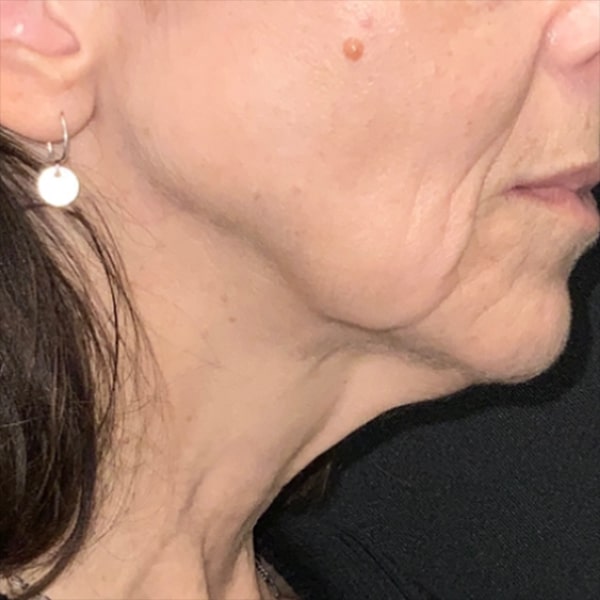 Thread Lift Before and After | Before Picture