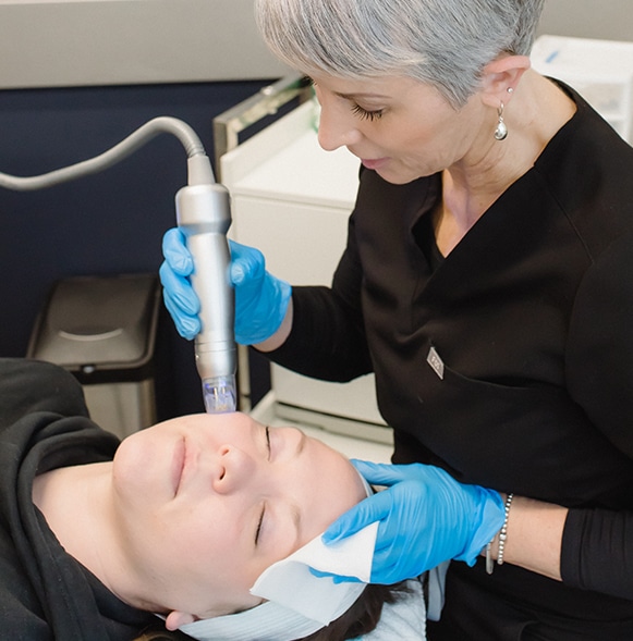 Radio Frequency Skin Tightening | Scarlet SRF on Cheek scarlet srf treatment to the midface