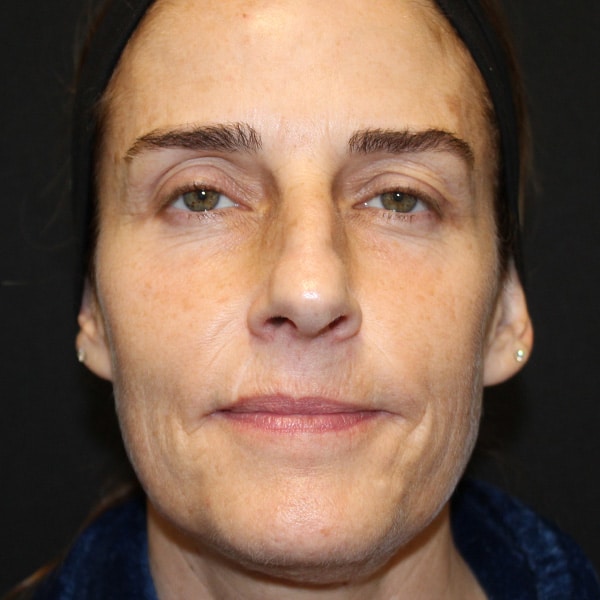 Sculptra® Aesthetic Gallery 15 Before