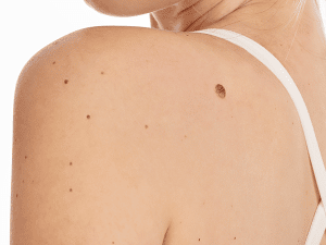 Remove skin tags