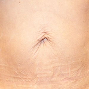 Sagging skin around the belly button