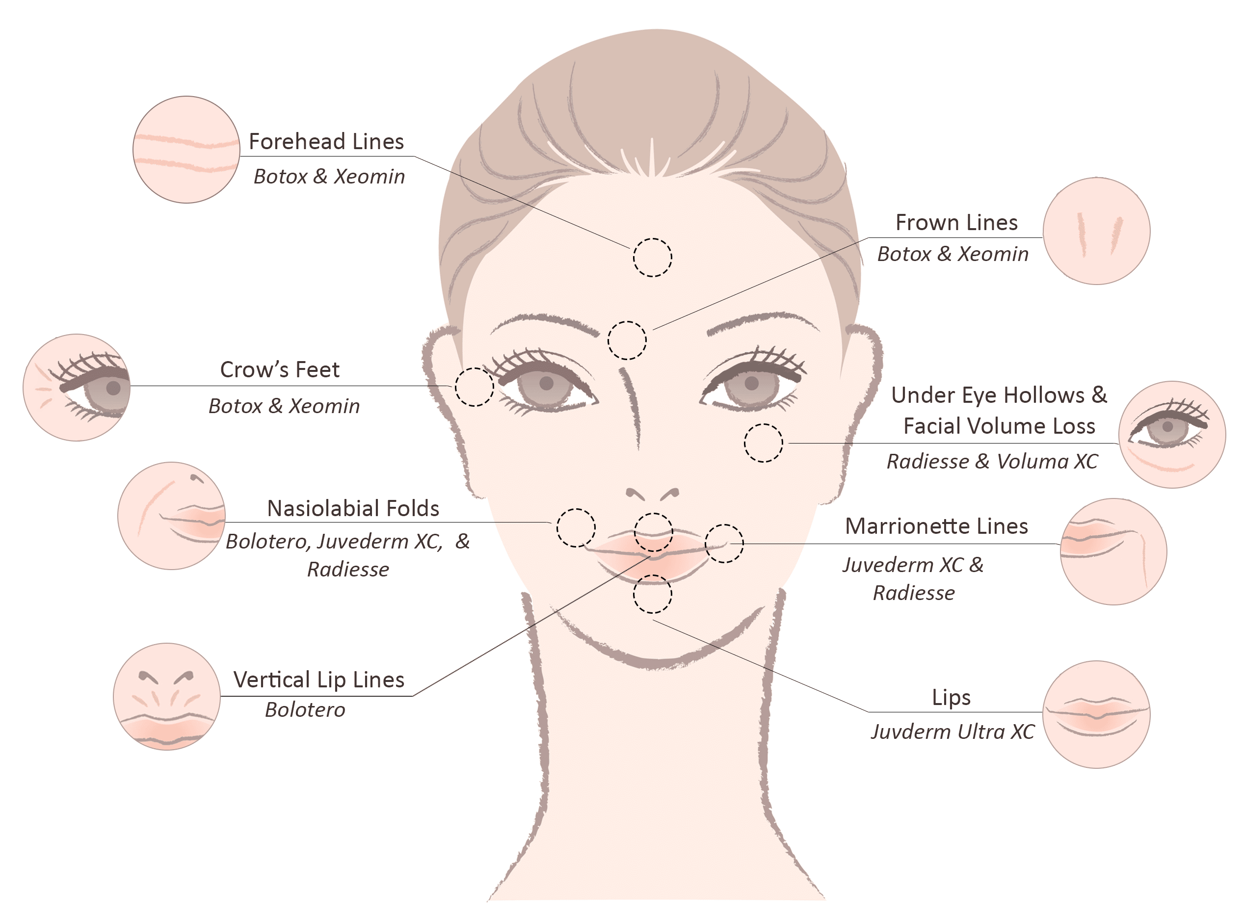 Tsitsis, Injectables - Infographic