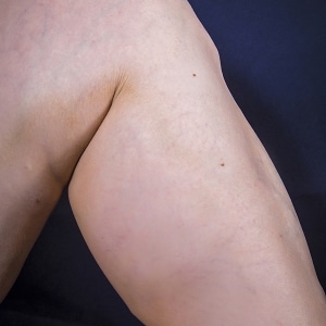 woman's calf without veins
