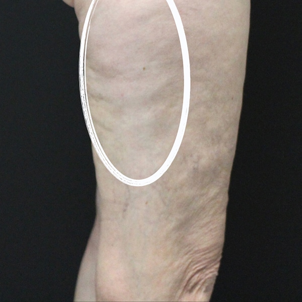 Side of woman's upper leg has cellulite