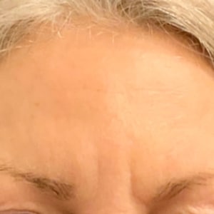 Botox Before and After | After Picture