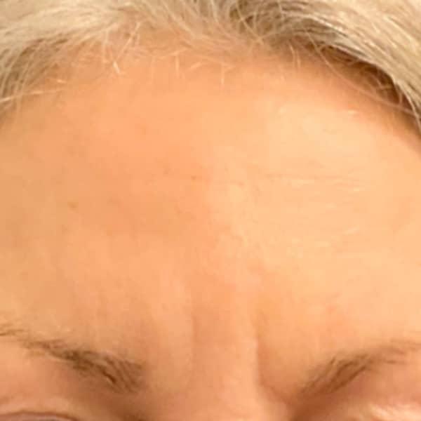 Botox® & Xeomin® 18 Botox Before and After | After Picture