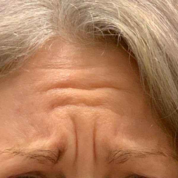 Botox Before and After | Before Picture