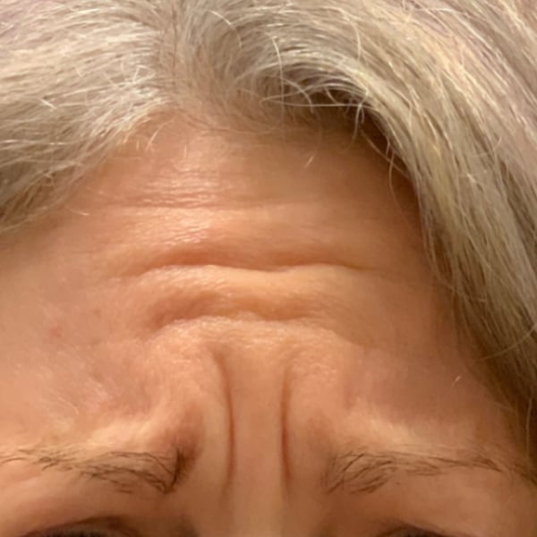 Botox® & Xeomin® 17 Botox Before and After | Before Picture