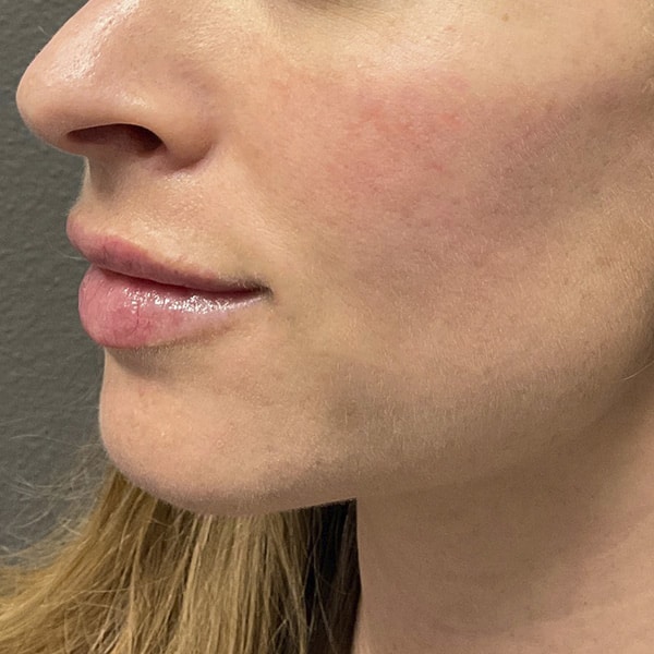 Dermal Fillers 40 After