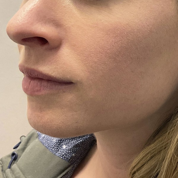 Dermal Fillers 39 Before