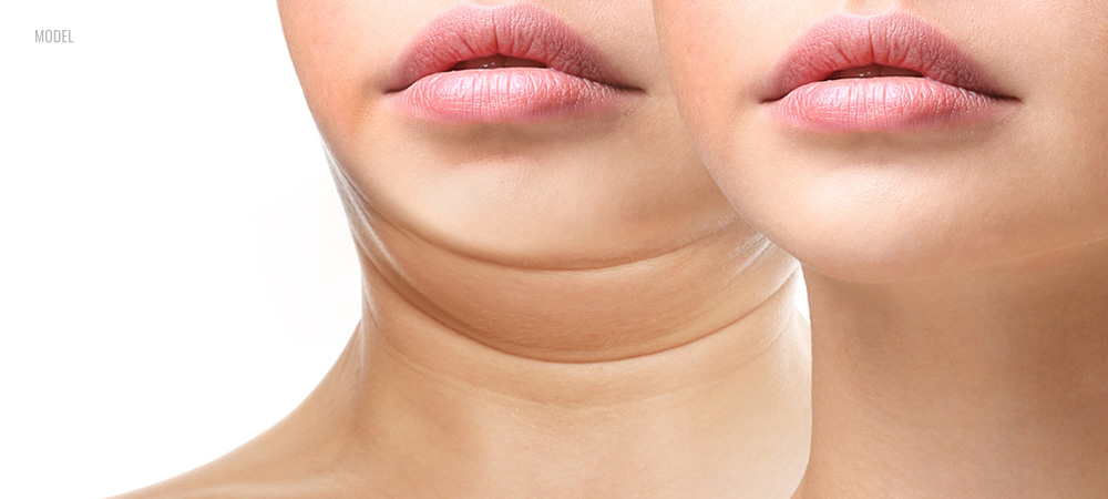 A before and after pic of a woman wearing pink lipstick who received treatment with Kybella®